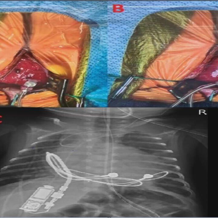 Louisville doctors implant tiny pacemaker in 28-week-old infant
